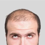  cure your baldness