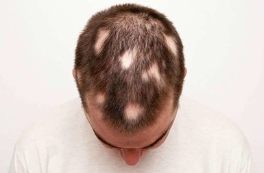 baldness treatment
