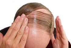  cure your baldness