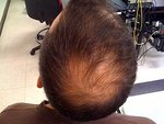 baldness treatment