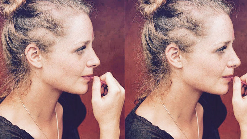  stop 
      balding now