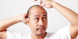baldness treatment