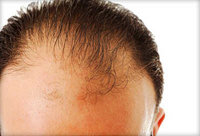 baldness treatment