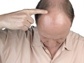 baldness treatment