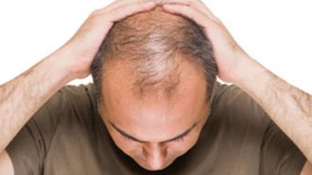 baldness treatment